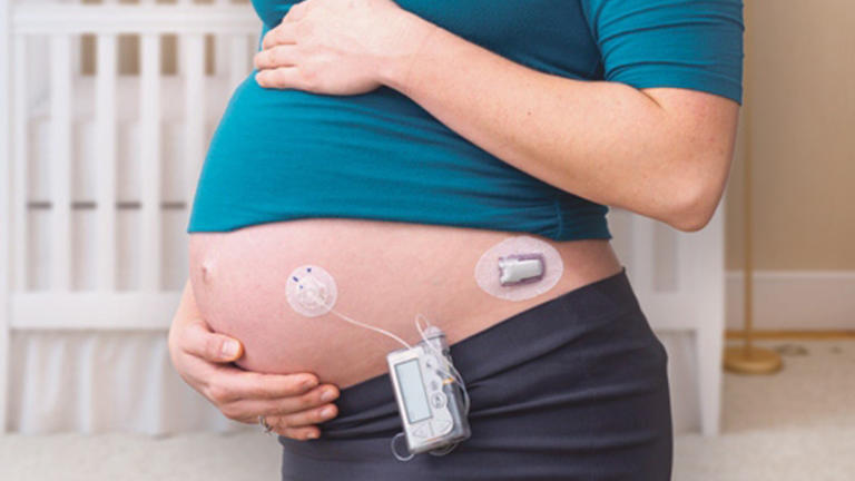 Pregnant Woman With a CGM