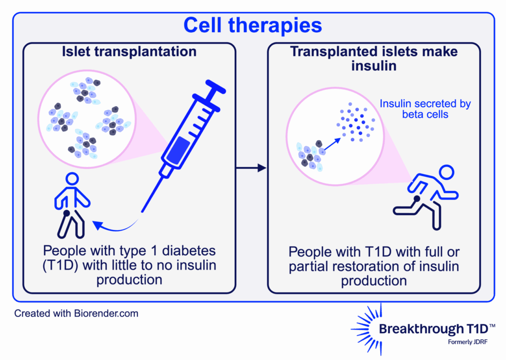 Cell therapies replace destroyed beta cells with external cells that make insulin