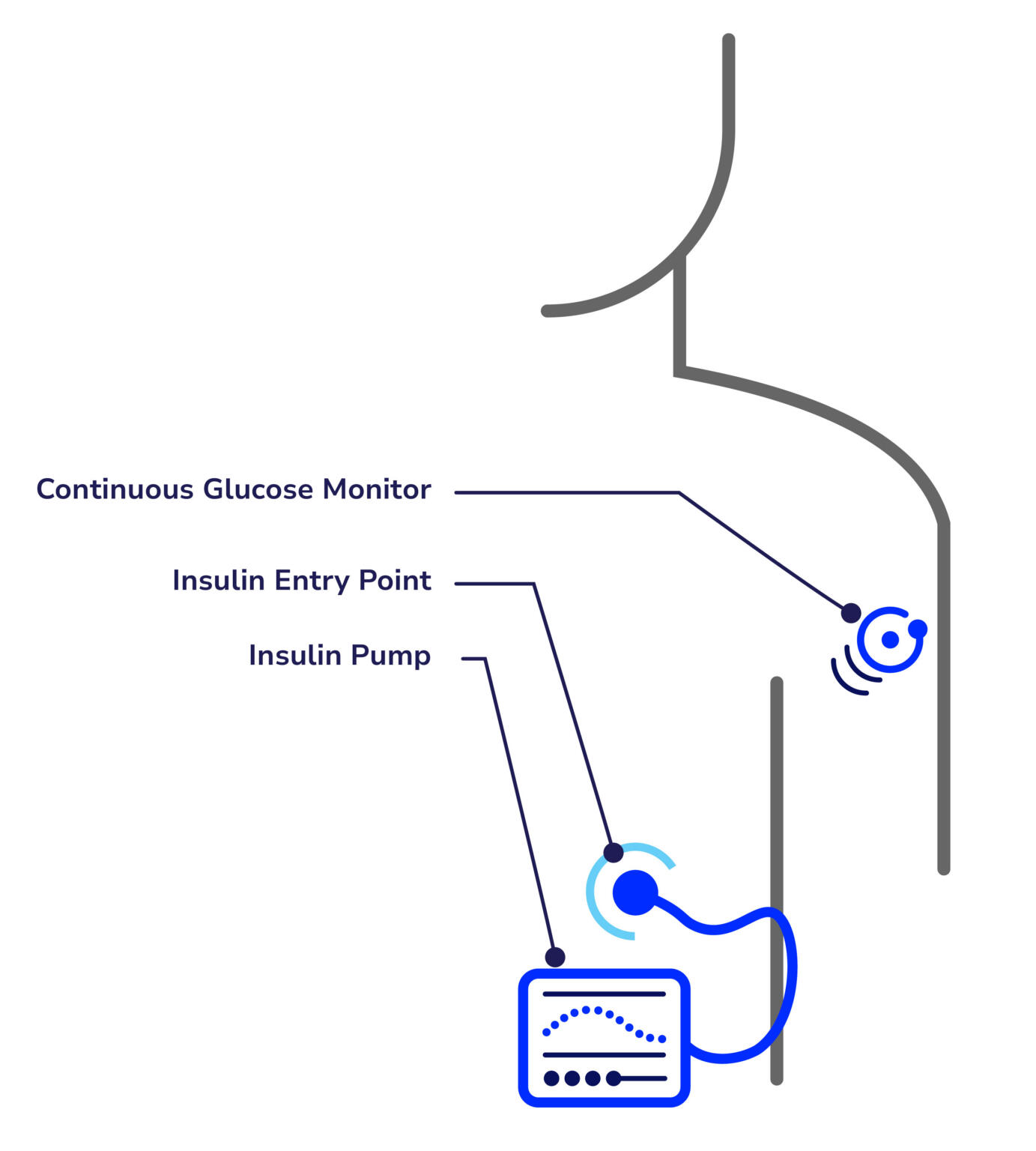 Automated Insulin Delivery Systems and Insulin Pumps - Breakthrough T1D