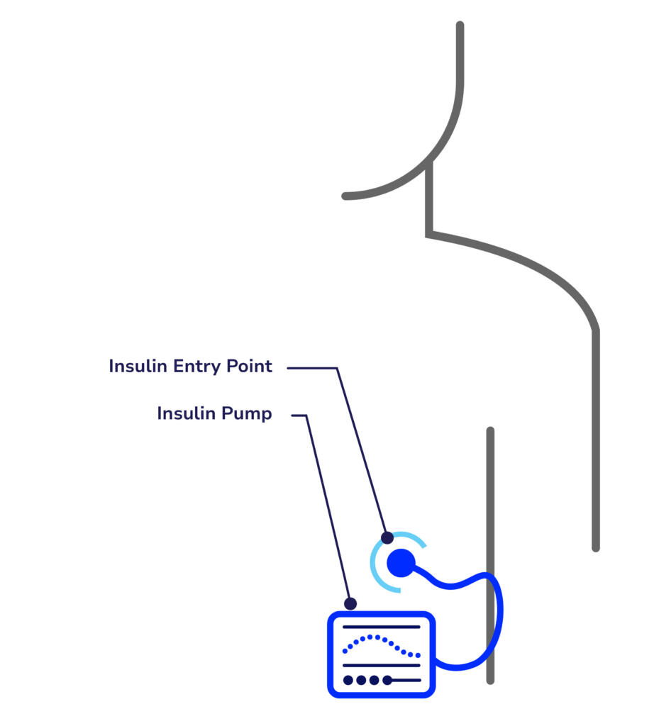 Illustration of how an insulin pump works