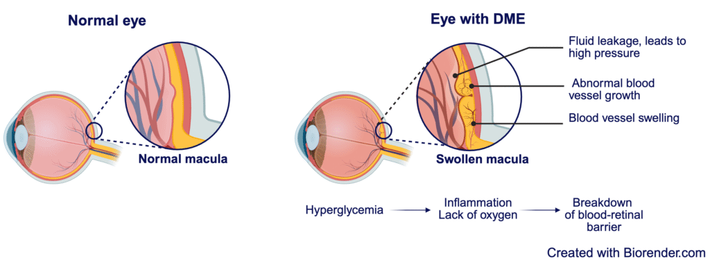 Illustration of diabetic macular edema