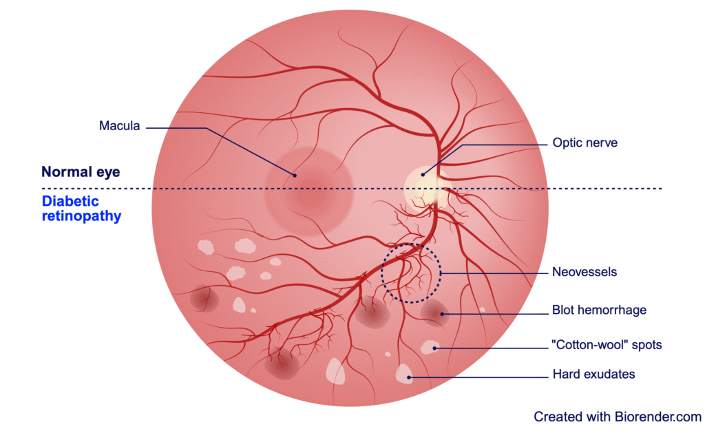 Illustration of diabetic retinopathy