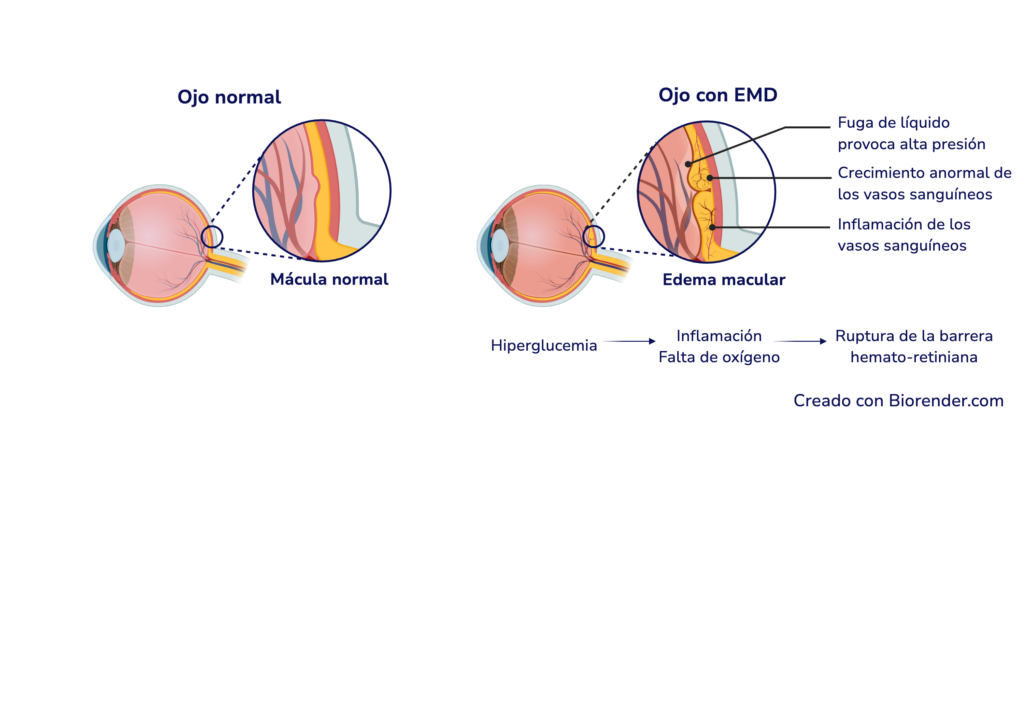 Edema Macular Diabético