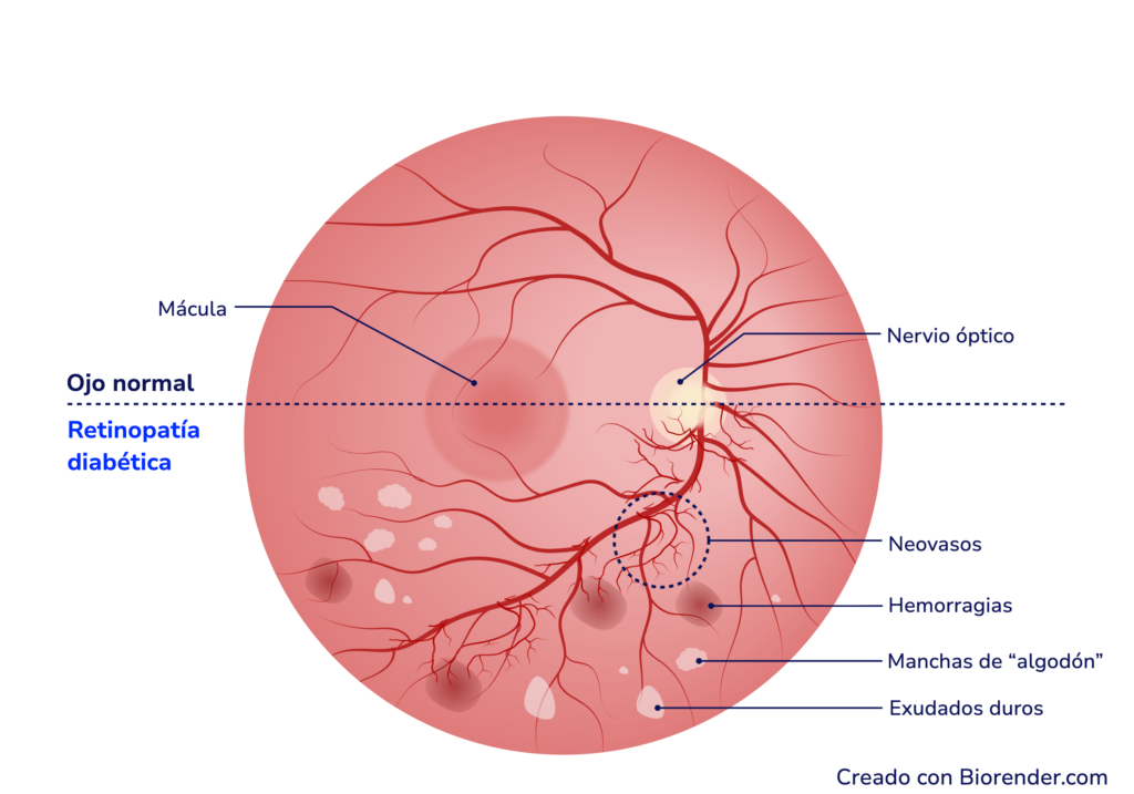 Retinopatía diabética